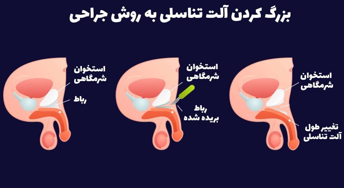 افزایش سایز آلت تناسلی با جراحی